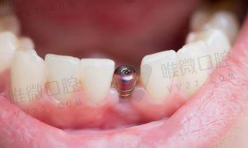 为何越来越多人选择深圳格伦菲尔口腔？原因竟然有这么多！