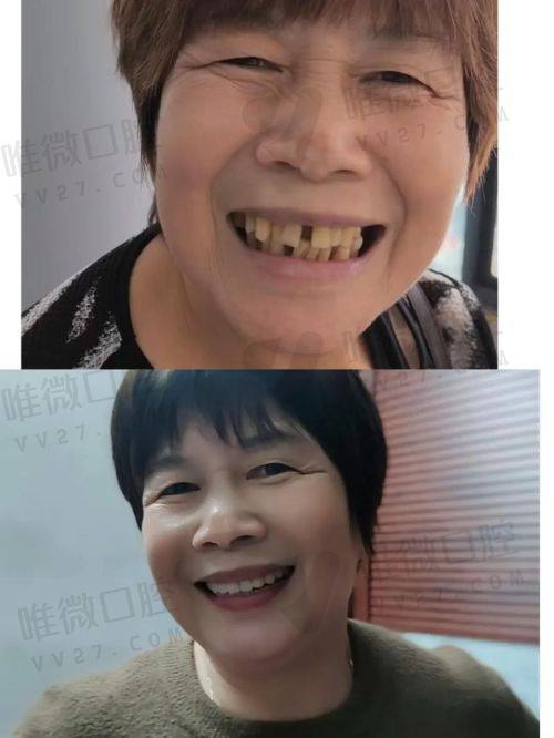 从“第一颗到整口”：价格越低越好吗？