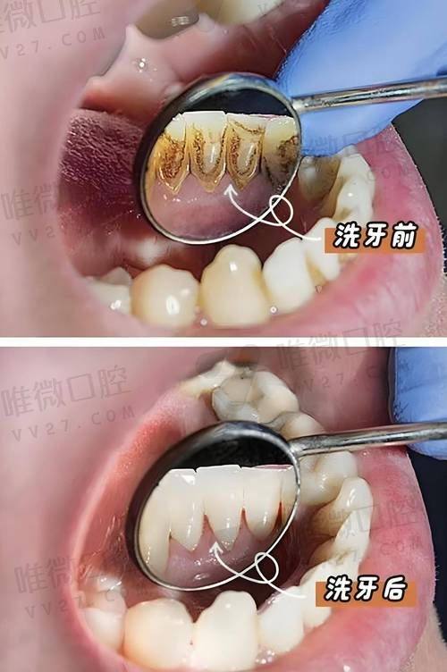 末尾说说牙冠和牙齿贴面，怕花冤枉钱的你得看看