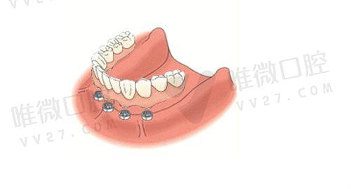 四、特色项目：这些技术让咸宁人告别异地看牙