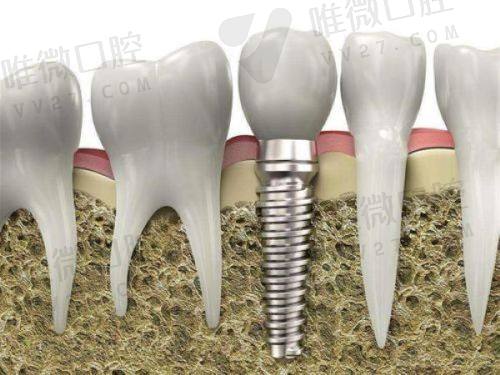 种植牙价格实锤亲民，公开透明让人放心