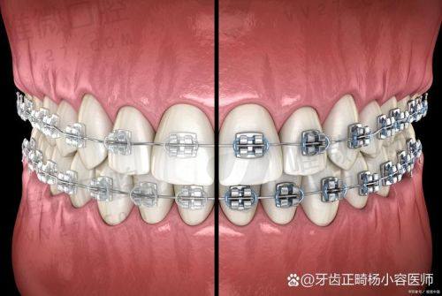 清华阳光矫正牙齿怎么收费2025？能用医保吗？答案都在这！ 
