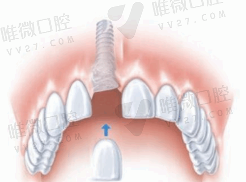 深圳格伦菲尔口腔20家分院攻略：不仅掌握口碑和地址还有价格表可以一览哦