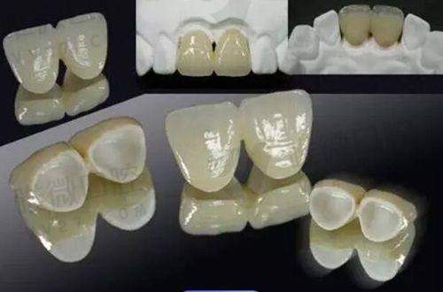 成都团圆口腔种植牙怎么样？连锁品牌、技术先进，多案例见证种植牙出色效果！