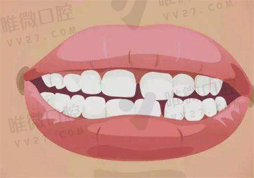 天津爱之和齿科的正畸医生靠谱吗？矫正过程有?；ぢ穑?></p><h3>天津爱之和齿科的正畸医生靠谱吗？矫正过程有?；ぢ?？</h3><p><strong>看牙当然不是只看价格！医生的水平才是决定正畸是否成功的关键因素。天津爱之和齿科的正畸医生多数拥有丰富的临床经验，擅长从青少年到成人的不同矫正类型。比如在网上被频繁提及的马宏斌医生、刘承医生，均有十年以上的临床执业经历，尤其在数字化正畸方面，熟练操作模拟系统，能提前预测矫治后的</strong>成效。</p><p>面诊时，医生会根据每一位患者的牙齿咬合情况、颌骨状况、面部比例，个性化定制矫正计划，不管是轻度的牙齿排列问题，还是复杂的骨性错颌畸形，都能给出专精建议及治疗方案，这点让不少患者放心。</p><p>而且整个治疗期间，爱之和非常注重复诊的规范和进度调整，会定期复查牙齿移动情况，必要时调整方案，确保矫治不走弯路、少走回头路。</p><p style=