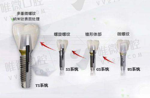补牙、根管、牙冠、贴面的价格也特别亲民
