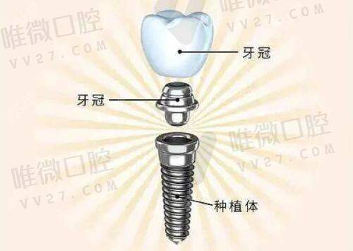6号牙拔了一直空着会怎么样？小心牙弓拥挤1.0mm间隙悄悄溜走哦！