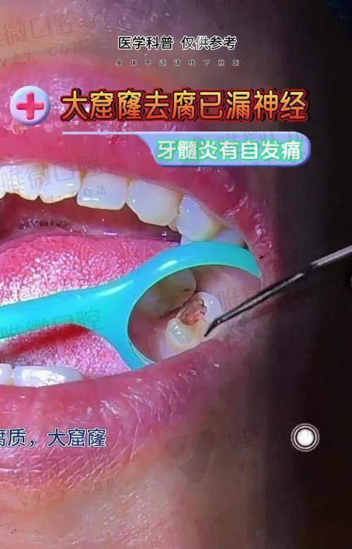 前牙根管治疗一颗牙多少钱？揭秘3次治疗背后的牙冠选择大作战！