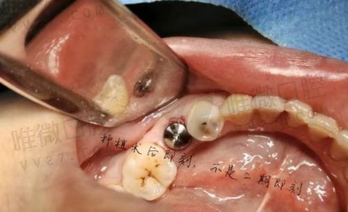深圳麦芽口腔医院种牙多少钱？港人跨境种牙福利与高存活率技术曝光！
