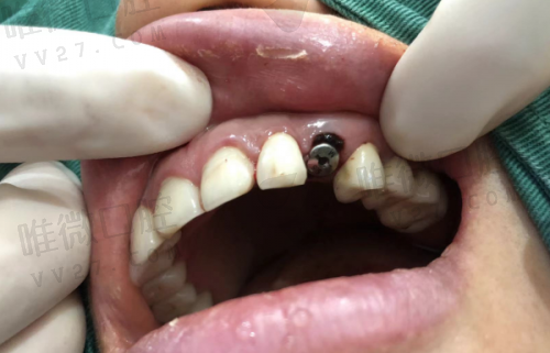 为什么种牙一定要选麦芽？价格之外还有这些“硬核”亮点