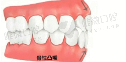 4. 流动树脂：细节控的精细武器