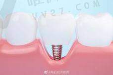 2025贵港蓝天口腔医院种植牙要多少钱？百康特2980+登腾3280+奥齿泰3880+贝格6980+