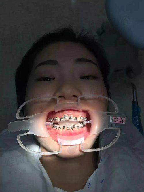 四、牙齿矫正