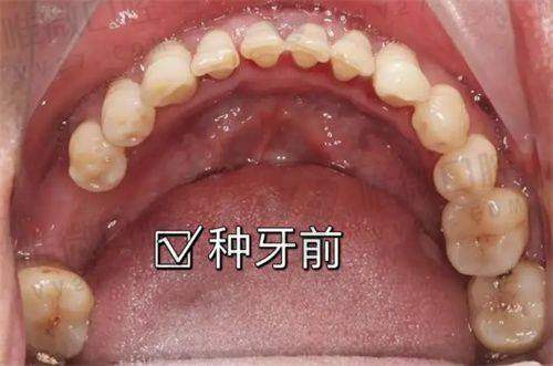 总结一下：这就是你种牙稳扎稳打的底气来源