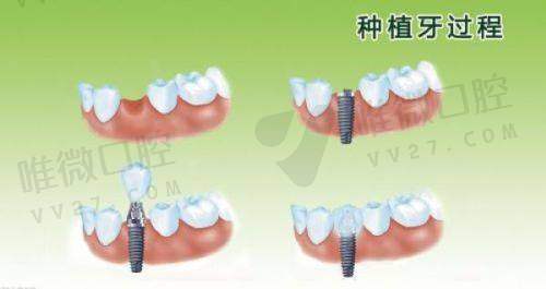 种植牙2980元起，这价格靠谱吗？