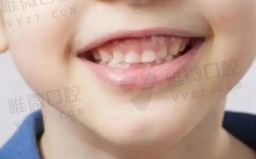 上海交通大学医学校附属第九人民医院:骨性修复+活动假牙精尖之选