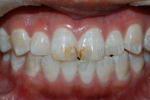 泰州拔牙价格参考：乳牙、智齿价格差距大