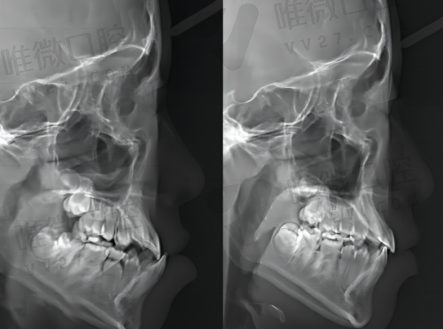 泰州补牙价格详解：用哪种树脂影响有多大？