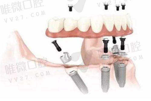 泰州种植牙多少钱一颗？揭秘当地种植牙价格区间及影响因素