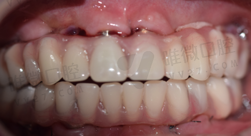 从“齿槽经费”看价格:一口牙齿也得算明白账