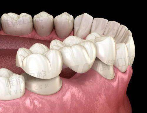 活动频繁,牙齿不好也别再“捂着”钱包了