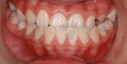 高品质种植体任你选,大品牌不再遥不可及