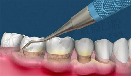 医生不建议清除掉牙石是真的吗？洗牙后牙缝会自动恢复吗