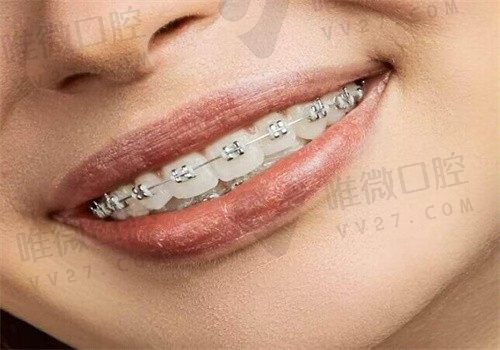 医生推荐钢丝不推荐隐形牙套，是因为隐形矫治器价格更贵吗