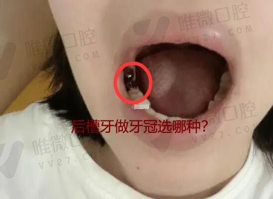 后槽牙做牙冠选哪种的？牙冠做了里面的真牙会不会慢慢烂？