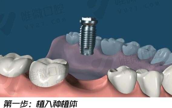 为什么良心医生不建议种植牙？了解下镶牙和种牙的优缺点在选择