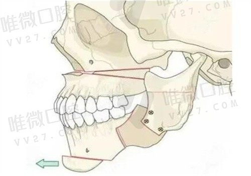 正颌手术毁我一辈子，终于明白为啥有正颌手术每年死多少人之问了