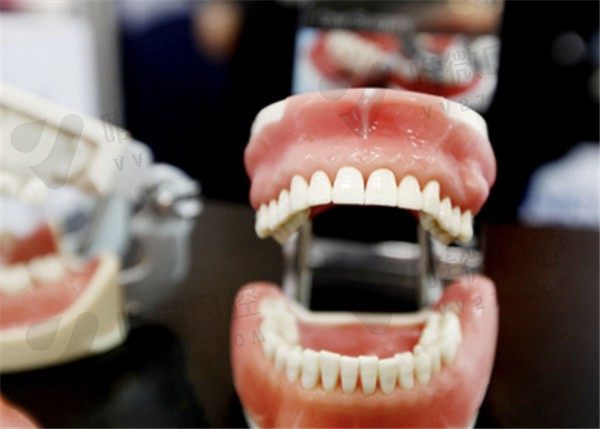种植牙哪个牌子好？分析排名前十种植牙品牌的质量和价格