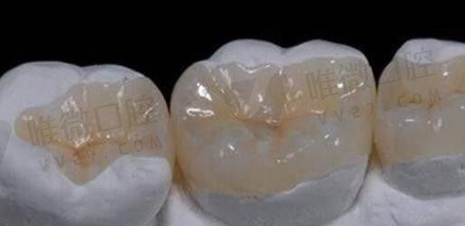 网上的补牙神器是真的吗？补牙材料150和300区别能管多少年？