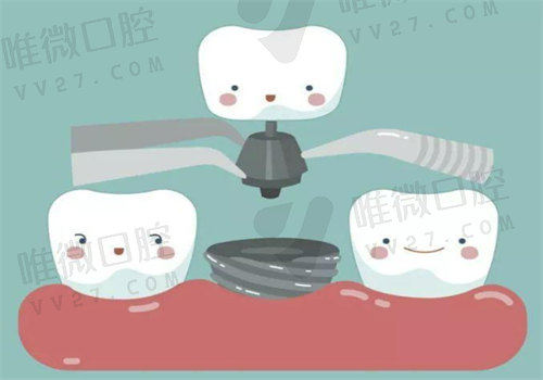 数字种牙和传统种牙哪个好？这两种技术如何选择咋区别呢   