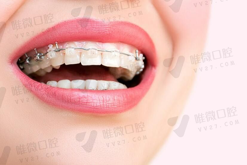 牙齿矫正贵不贵影响因素有哪些？根据不同牙套了解牙齿矫正