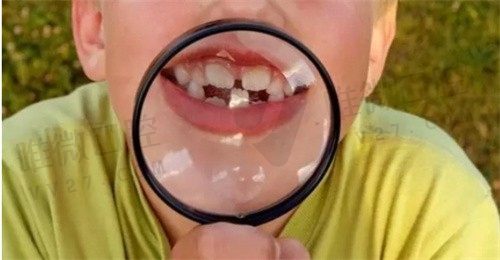 儿童门牙不齐越早矫正越好吗？看小孩纠正大门牙最佳时间及方法