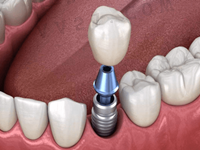 分享固定义齿和种植牙的区别，看种植牙好还是固定义齿好？