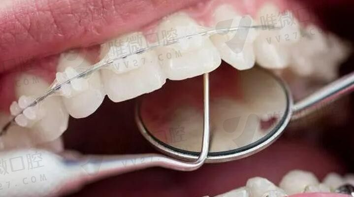 牙齿矫正最难受的阶段是哪个阶段？看看网友牙齿矫正经历分享就知道了
