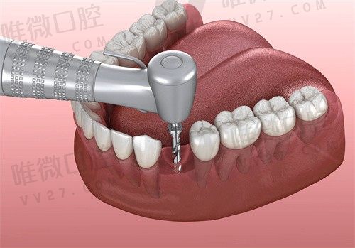 现在做种植牙都是微创技术治疗吗？国内微创种植牙医院榜单揭晓