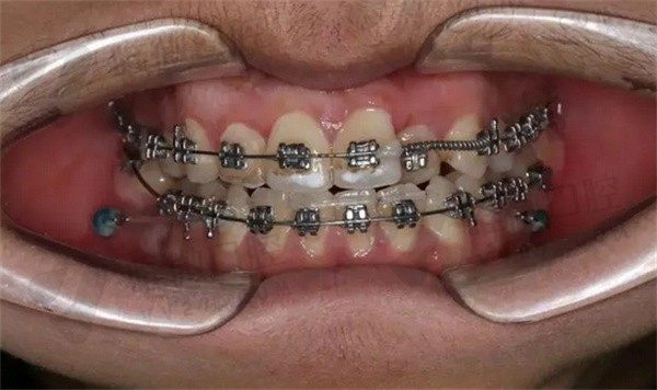 喊话医生,小孩遗传性龅牙可以矫正吗？几岁可以矫正及会反弹吗