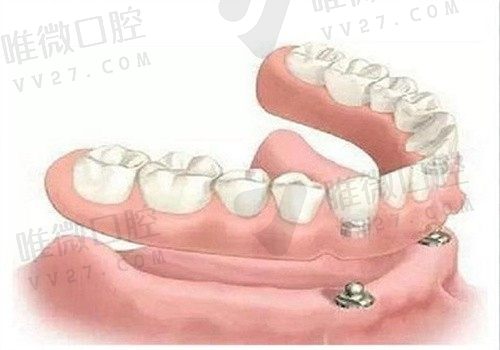 半口牙缺失最好的治疗方案集齐（all-on-4/6,半口半固定,穿颧穿翼）