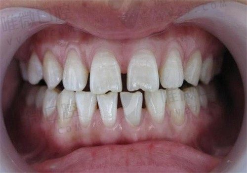 为什么牙医都不愿意补牙缝？快来看具体原因和靠谱的修复方式