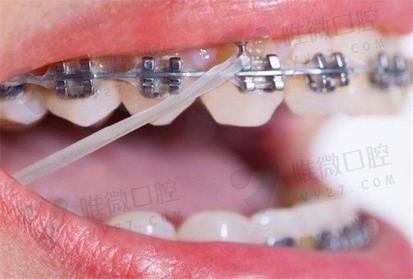龅牙一般能收几毫米？内收3mm,4mm,5mm能改善嘴突吗变化明显不