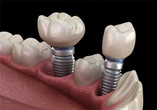 上下牙间距太小无法种植牙怎么办？来看看这些修复方式能否帮到你