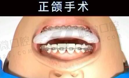广州广大医院正颌手术好还是中山大学附属口腔医院?医生和价格大比拼