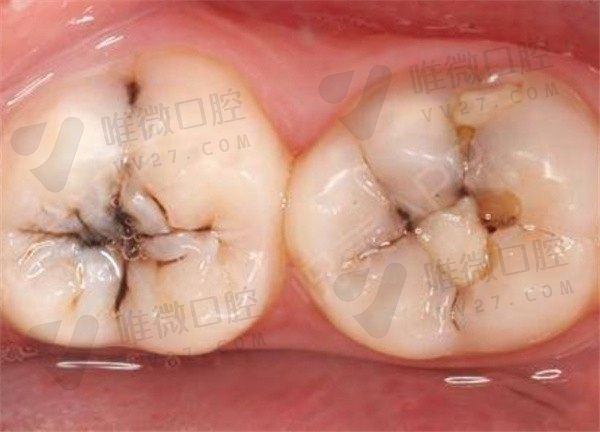 窝沟龋医生不建议补牙该怎么治疗？看看白龋齿和黑龋齿的区别就知道了