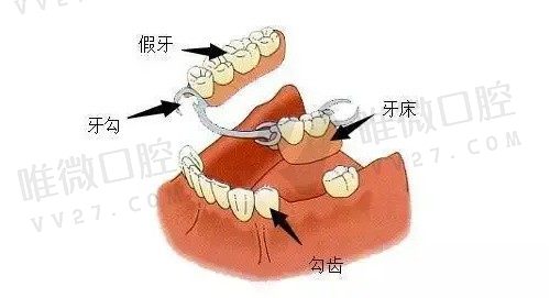 可摘义齿多少钱一颗？2023北京可摘义齿价格表和医院名单出炉