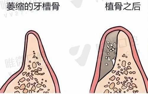 牙骨萎缩怎么才能恢复？引导组织再生术或牙周植骨术都可改善