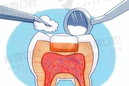 义获嘉美学树脂和p60哪个好?树脂补牙材料对人体有害吗