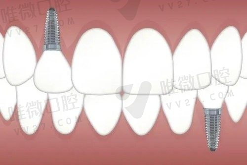 牙槽骨宽度不够可以种植牙吗?牙槽骨宽度不够找准这六个方法就对了